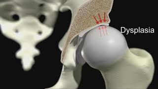 Acetabular Dysplasia