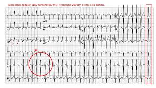 Taller de Electrocardiografía "Diagnóstico de Arritmias Complejas"