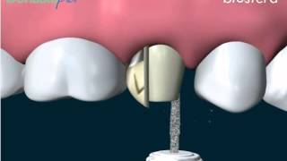 Cos'è una Corona, o capsula, in porcellana?