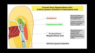 Animation on Artificial Ligament Substitute in Augmenting Hip Joint Capsule with Polypropylene Mesh