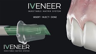 IVENEER Enjeksiyonluk matris sistemi - IVENEER   Injectable matrix system