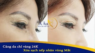 BVTM Á Âu - Xóa Nhăn Vùng Mắt Với Chỉ Vàng 24K Của Mỹ