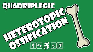 Heterotopic Ossification (HO) Explained | Quadriplegic (C5,C6,C7)