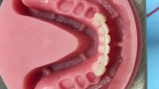 Full digital denture with 2 milling steps