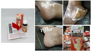 Obat kaki pecah pecah dan kaki kapalan