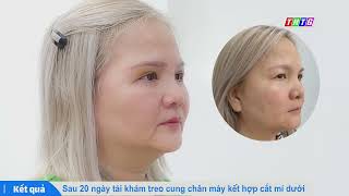 Nâng Cung Chân Mày Kết Hợp Lấy Mỡ Bọng Mắt Chia Sẻ Của Bác Sĩ Lê Văn Vĩnh - Truyền Hình Tiền Giang