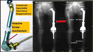 Growing Joint or Expandable Total Femur Megaprosthesis: How expansion of joint was performed