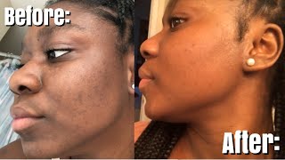 HOW TO GET RID OF HYPERPIGMENTATION & DARK MARKS | Jay Shant’e