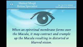 Epiretinal Membrane  - Mr Mahi Muqit PhD FRCOphth