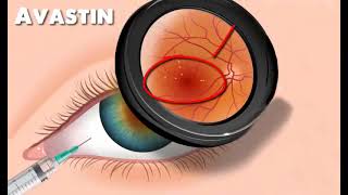 Intravitreal Therapy Options For Eyes  - Mr Mahi Muqit PhD FRCOphth