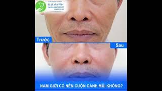 Thu gọn cánh mũi cho nam giới là gì ? Những ai nên thực hiện ? chi phí bao nhiêu ?