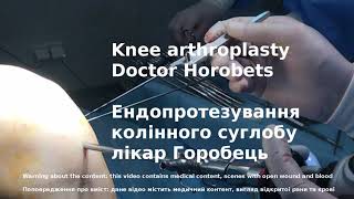 Knee arthroplasty uncensored (with blood), doctor Horobets