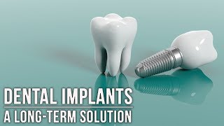 Three questions you should ask before getting dental implants