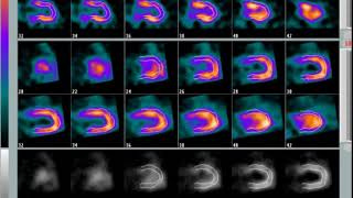 Gammagrama SPECT Cardiaco