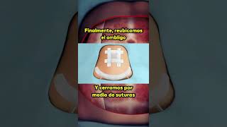 Cómo se realiza una abdominoplastia? #shortvideo