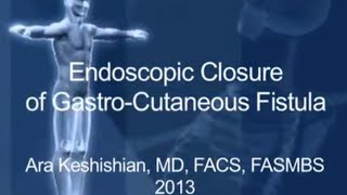 Endoscopic Closure of Gastro-Cutaneous Fistula