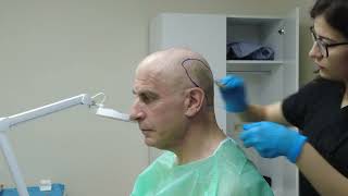 Michael's Hair Transplant Journey in Turkey I Clinic International