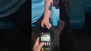 🟣ICTUS: Compex en miembro superior👉Mejora mano en garra (patrón de cierre) con electroestimulación