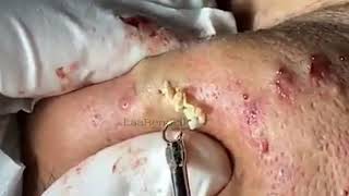 Acne removal   Big Blackheads & Whiteheads