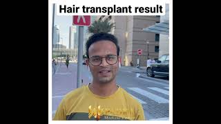 Hair transplant result at Padra Medical center Dubai #hairtransplant #uae #dubai