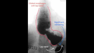 Dilated Esophagus