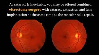 Treatment of Macular hole By Mahi Mukit