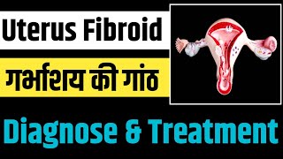 Multiple Uterus Fibroid & Kidney Stone : Patient Diagnose and Ayurvedic Medicine @HelloUpchar