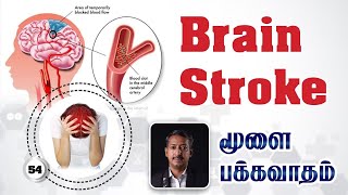 மூளை  பக்கவாதம் /  மருத்துவ சிகிச்சையின் முக்கியத்துவம்  / Brain Stroke / Care To Cure