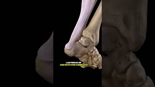 Ruptura del Tendón de aquiles, TENDON ROTO #traumatologia #tendon