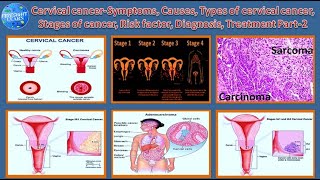 Cervical Cancer|Causes, Types , Stages of cancer, Risk factor, Diagnosis, Treatment Part-2