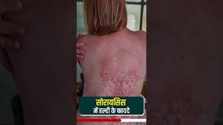 Psoriasis flake removal | सोरायसिस में हल्दी के फायदे | क्या हल्दी से सोरायसिस ठीक हो सकता है #viral