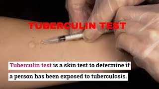 HOW TO DO TUBERCULIN TEST (PPD).