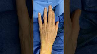 Hand Rejuvenation - Fat Transfer to Hands 👏🏾