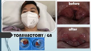 TONSILLECTOMY / GA | RECOVERY | RAD CYCLIST