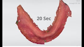 Scannning edentulous mandible in 20 seconds!