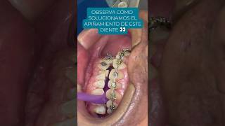 APIÑAMIENTO DENTAL