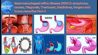 Gastroesophageal reflux disease GERD  symptoms, causes, Diagnosis, Treatment, Medicines, Surgery and