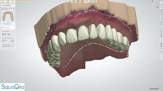 Digital single arch immediate denture.