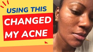 My Acne Transformation: Unveiling the Simple Trick!