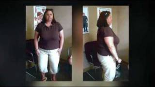 Sue after Roux-en-Y Gastric Bypass Surgery