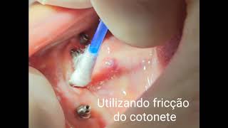 Como remover parafuso protético fraturado em minipilar?