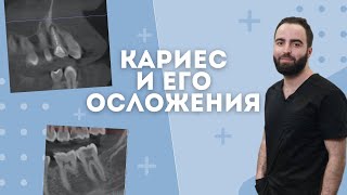 КАРИЕС И ЕГО ОСЛОЖНЕНИЯ