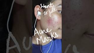 How i fade my acne marks #acnetreatment #acnescars #fadeacnemarks #acnepimples  #removeacnescars