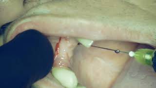 Infiltration anesthesia technique for implantation missing 1.2 teeth.