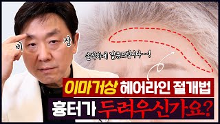 이마거상 헤어라인 절개법 │이마거상 절개법 흉터가 크게 남는다고요? - 의학박사 백승준