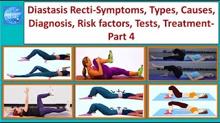 Diastasis Recti Symptoms, Types, Causes, Diagnosis, Risk factors, Tests, Treatment Part 4