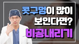 비공내리기 👃🏼 #들창코 #용코 #콧구멍내리기