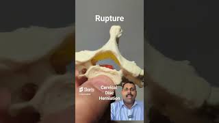 Cervical disc problems