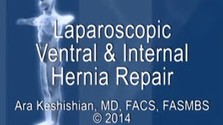 Laparoscopic Ventral and Internal Hernia Repair