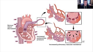 LV Failure and PPV, hemodynamic effects of positive pressure ventilation